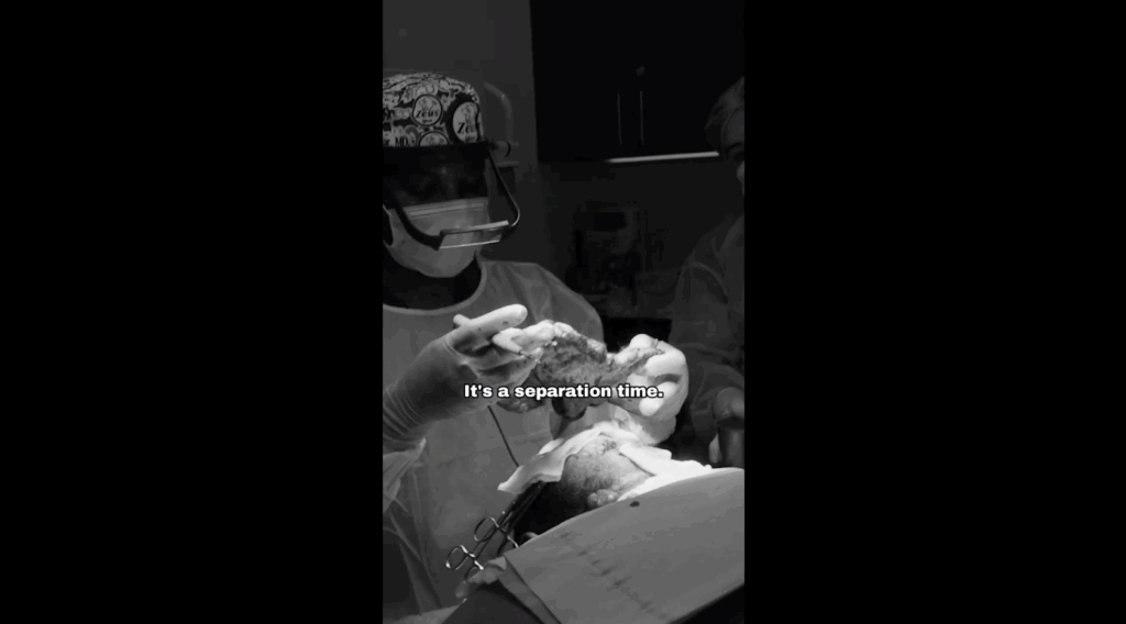 Dr. Sanusi Umar has successfully removed the diseased portion of Anwar’s scalp using a non-traditional approach.