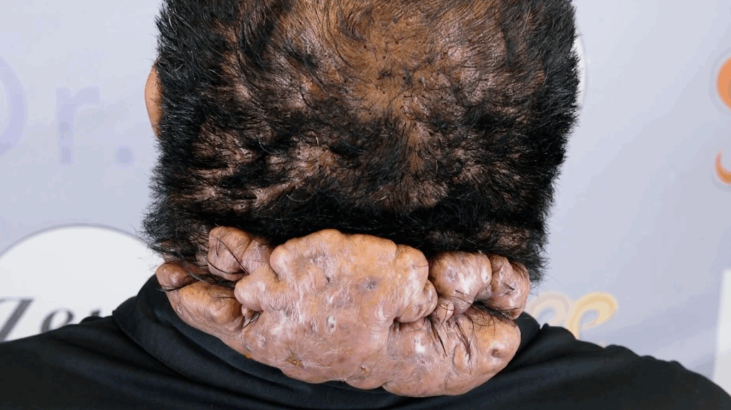 Close-up view of the back of a John’s head showing a severe scalp condition with large, inflamed, nodular masses covering the nape of the neck.