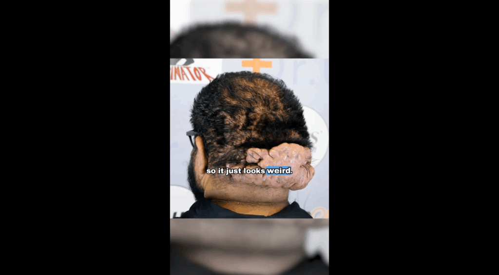  John Picone’s inflamed scalp cysts on the back of the head.