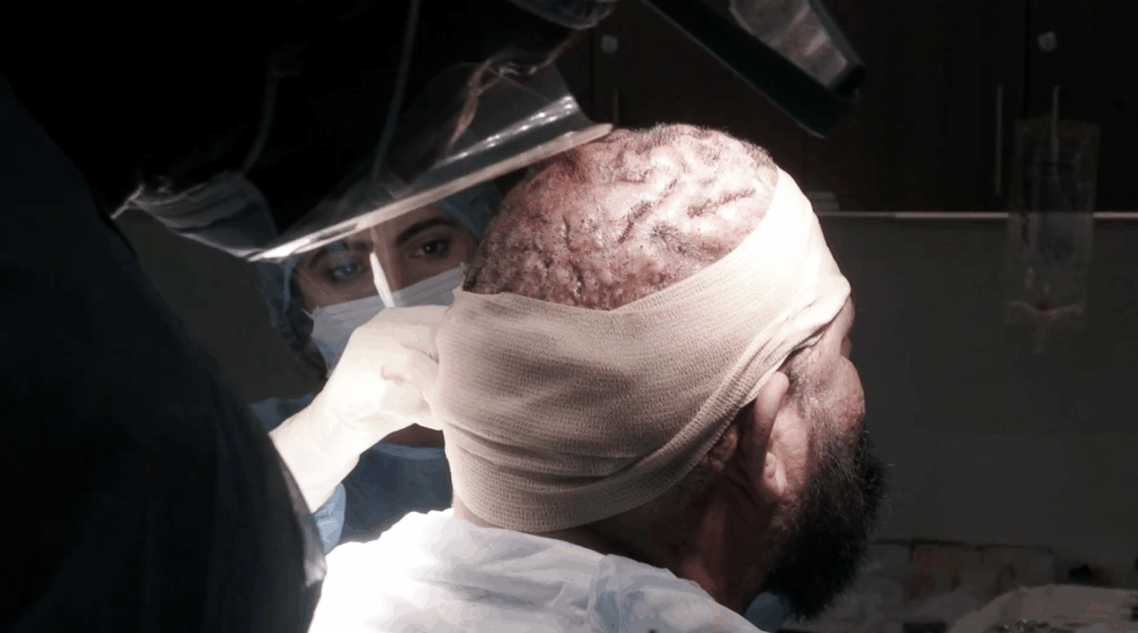 A close-up look of John's head after the successful surgery to remove his acne keloidalis nuchae bumps.