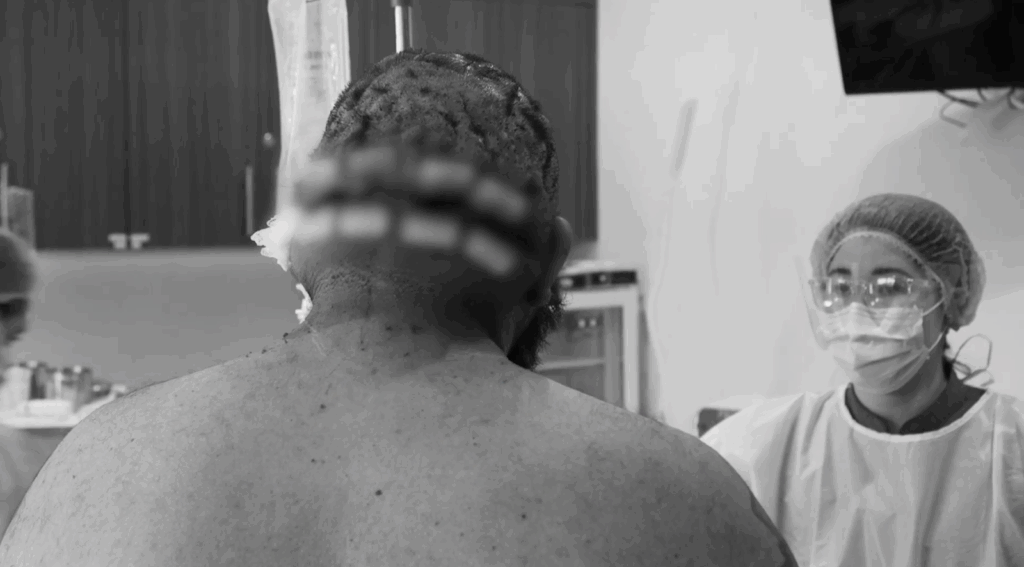 John’s back of the head after the surgery to remove the AKN lesions on his scalp.