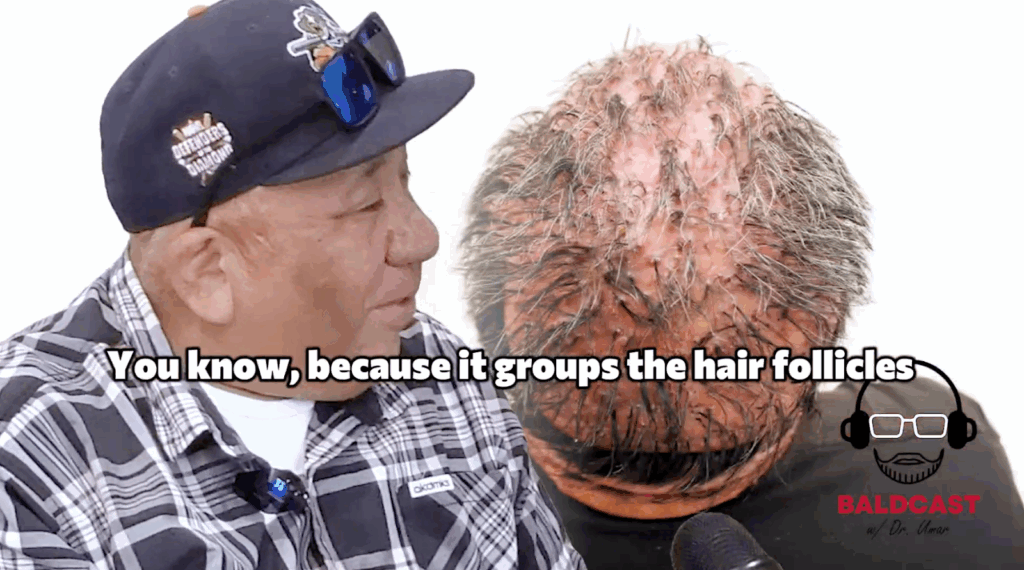 obert describes how his hair follicles grew into groups, which look like doll’s hair. This has made him wear hats, beanies, and bandanas to cover up his scalp.