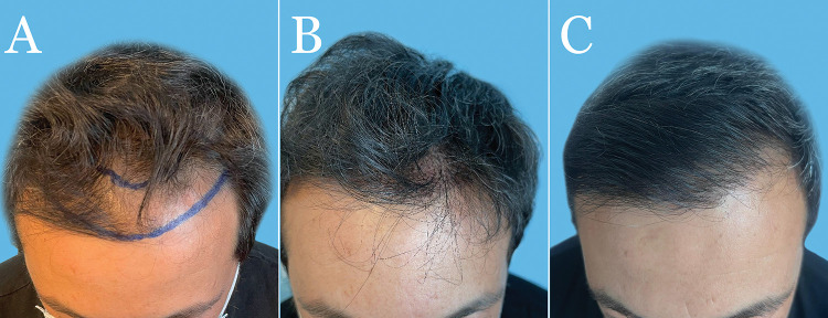 As shown in the publication, patient went through long-hair FUE, and 3289 grafts were implanted to the frontal scalp. This results in a natural-looking hairline the moment surgery ended.