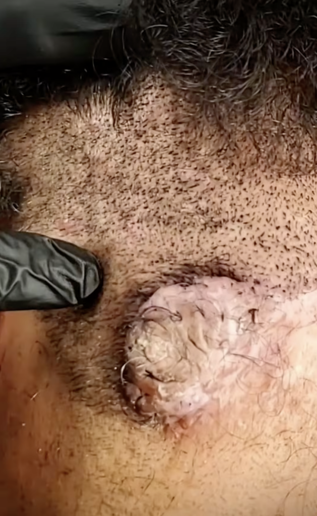 Close-up of the lower scalp and neck with short hair and a raised skin lesion.