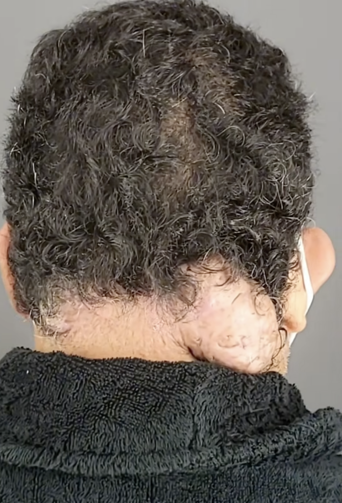 Rear view of curly hair and a raised area near the lower hairline.