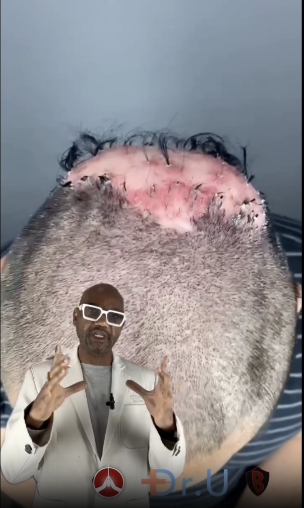 Close view of the back of Dennis’s shaved scalp with a large pink raised area and Dr. Umar in the foreground.