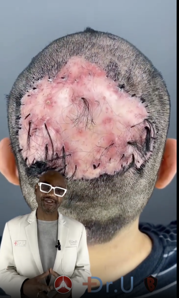 Rear view of a shaved scalp with a large irregular pink raised area and Dr. Umar pictured at lower left.