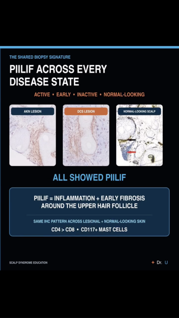 Research graphic with three biopsy images labeled AKN lesion, DCS lesion and normal-looking scalp, stating that all showed PIILIF.