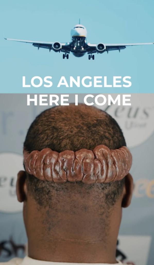 Airplane above a rear view of Marcus’s head with a large raised growth across the lower scalp.