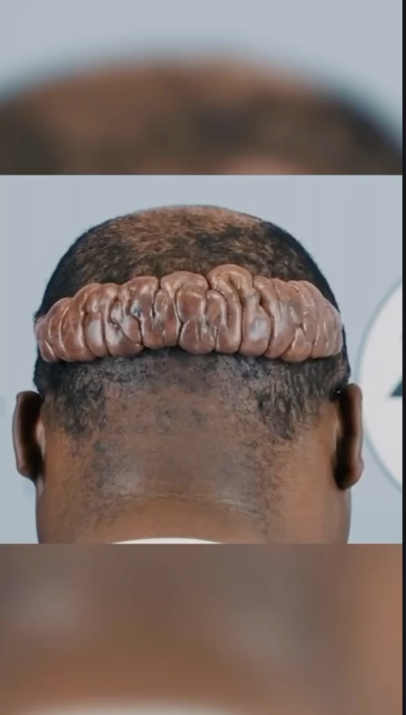 Rear view of Marcus’s head showing a large raised growth across the back of the scalp.