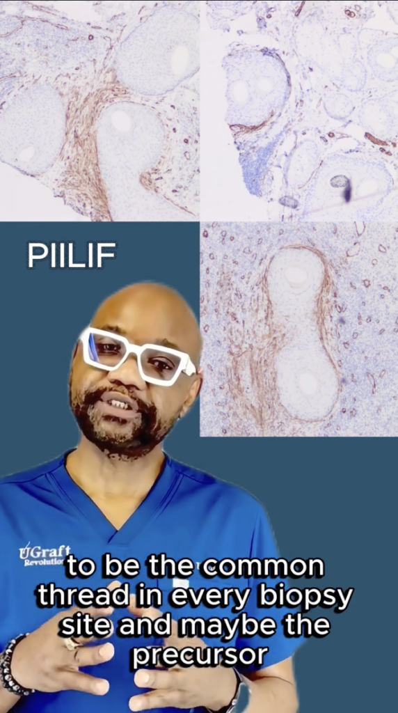 Microscopic tissue images with the label PIILIF and Dr. Sanusi Umar speaking in blue scrubs.