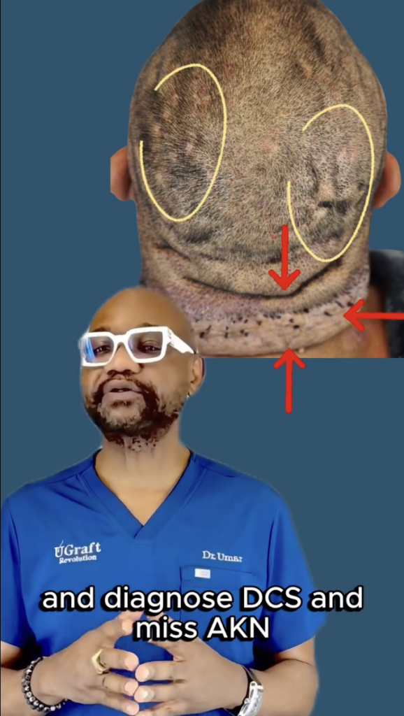 Rear scalp image with highlighted areas and arrows above Dr. Sanusi Umar in blue scrubs.