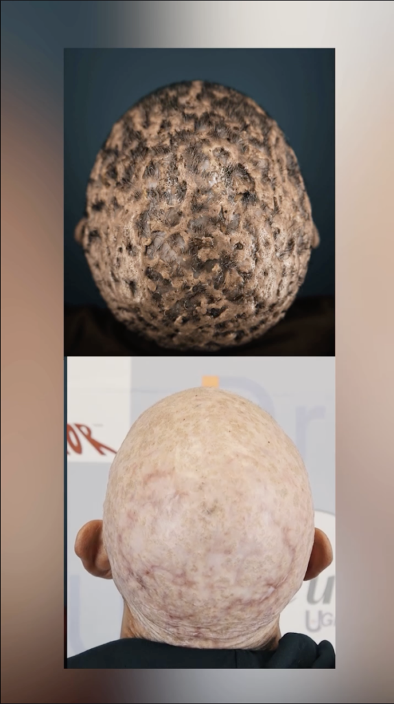 Two vertically stacked rear scalp views, with a textured scalp in the upper image and a closely shaved scalp in the lower image.
