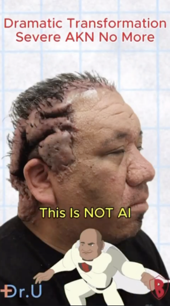 Side profile of Robert with prominent raised and folded areas across the scalp.