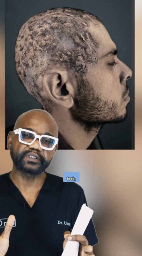 Dr. Sanusi Umar speaking below a side-profile photograph of a man’s scalp and face.