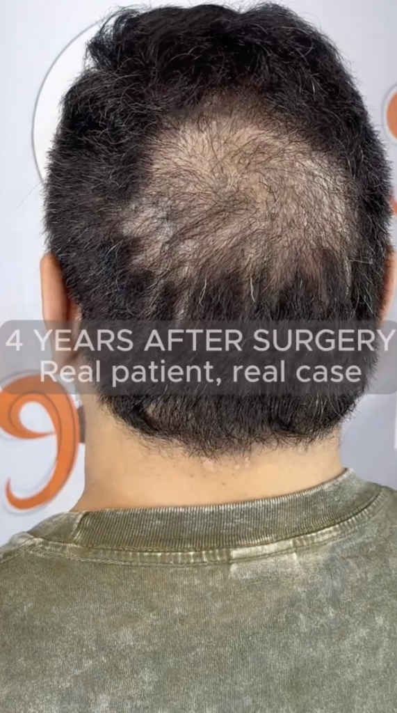 Rear view of a man with short dark hair and a thinner area at the crown, labeled four years after surgery.