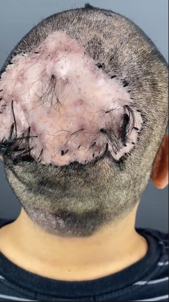 Rear view of a shaved scalp with a large pink area and scattered hair strands.