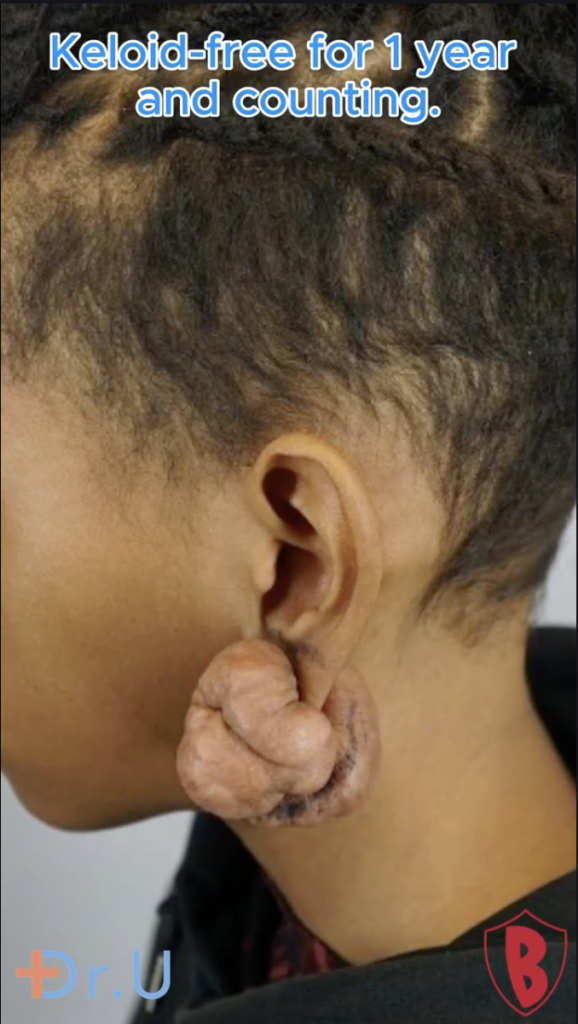 Side view of an ear with a large raised growth around the lower earlobe, with Dr. U branding and text reading keloid-free for 1 year and counting.