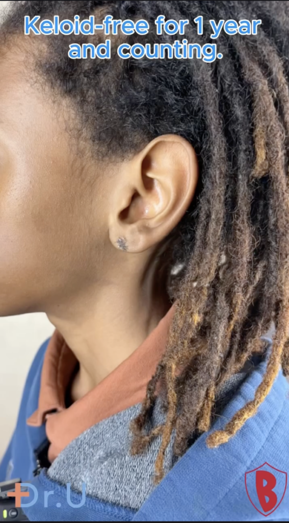 Side view of an ear and locs with text reading keloid-free for 1 year and counting, plus Dr. U and Bumpinator branding.