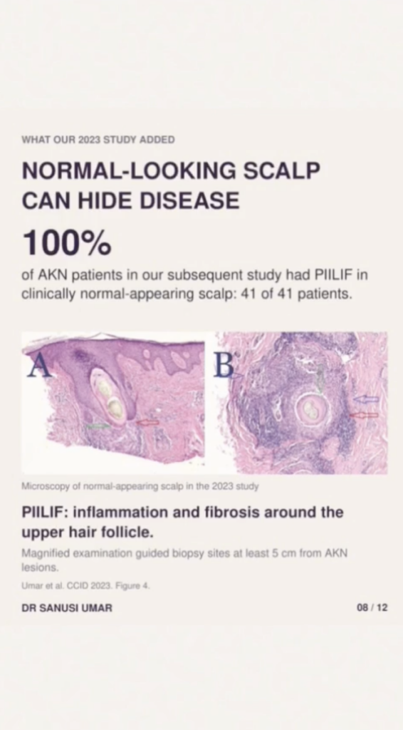 Research slide with the heading Normal-Looking Scalp Can Hide Disease, a 100% statistic, and two microscopy images.
