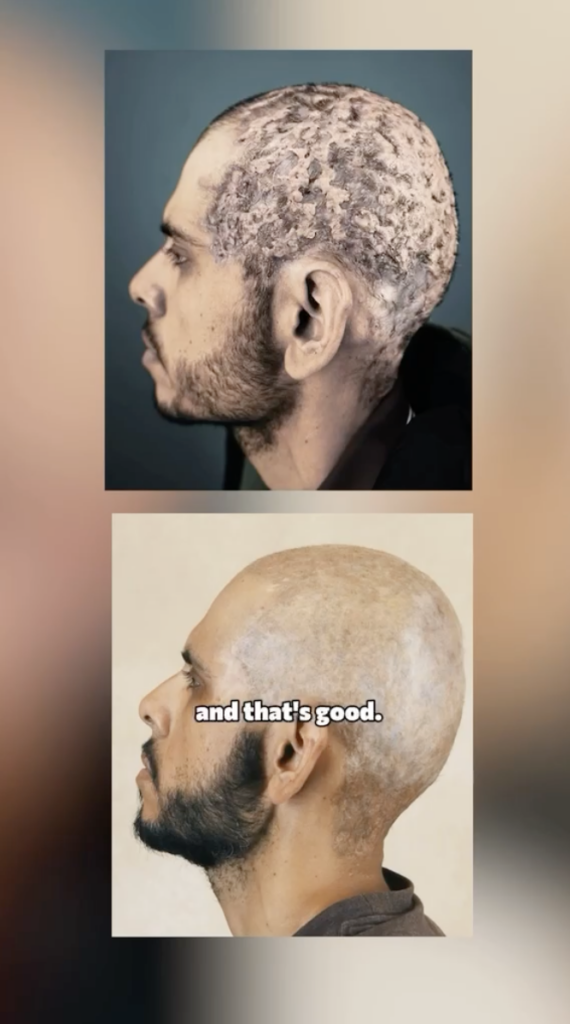Two stacked side-profile photographs of the same man, with visible differences in the scalp and hair between the images.