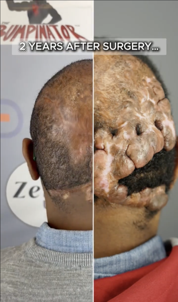 Split-screen comparison of the back of a scalp, with prominent raised areas on one side and a flatter appearance on the other.