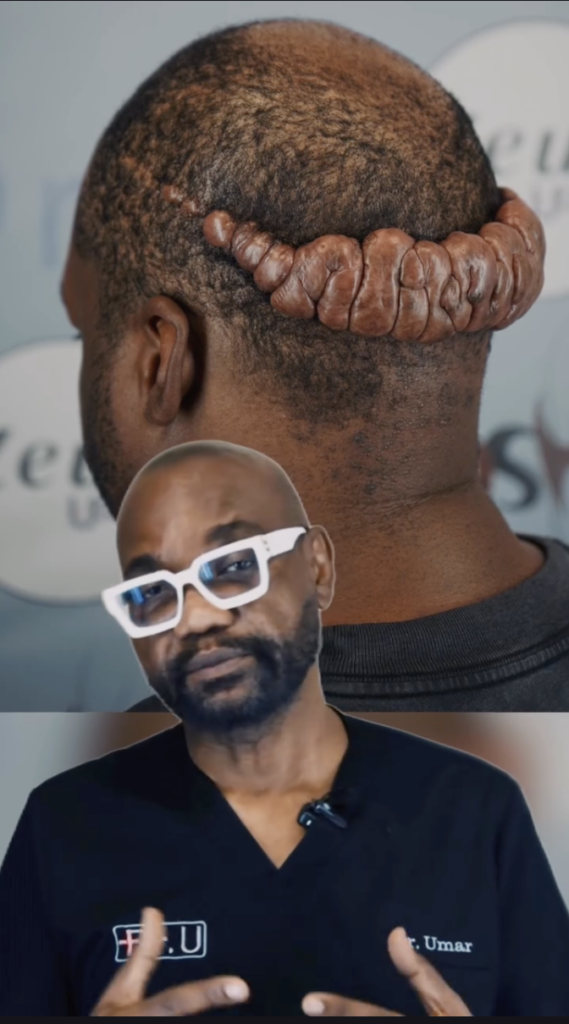 Composite video frame showing a raised band of tissue across the back of a person’s scalp and Dr. Umar speaking below.