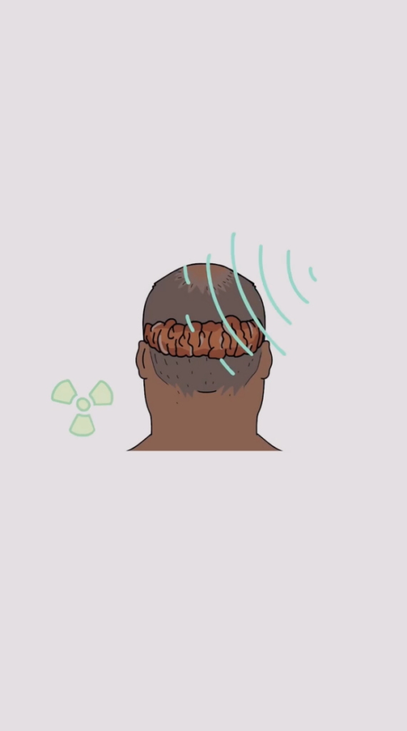 Illustration of the back of a head with a raised band across the scalp, teal curved lines, and a small radiation symbol.