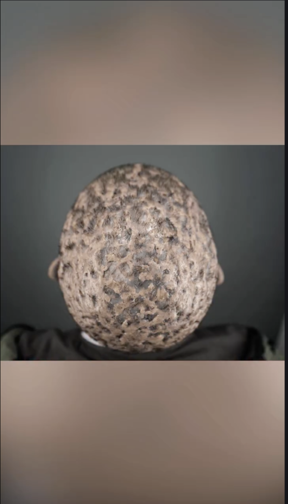 Top-down view of a scalp with numerous visible patches and irregular areas.
