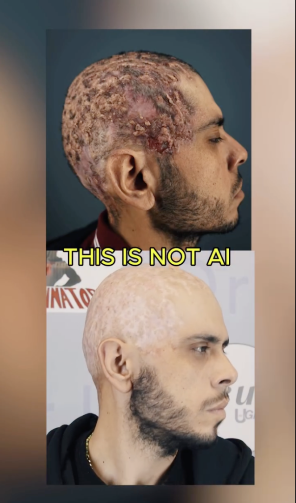 Two side-profile photographs of a man, one showing raised scalp areas and the other showing a closely shaved scalp.