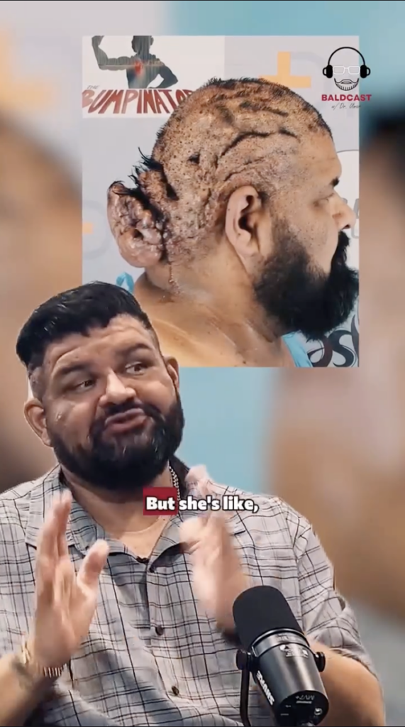 A bearded man speaking at a microphone beneath an inset photograph showing the side and back of a scalp.
