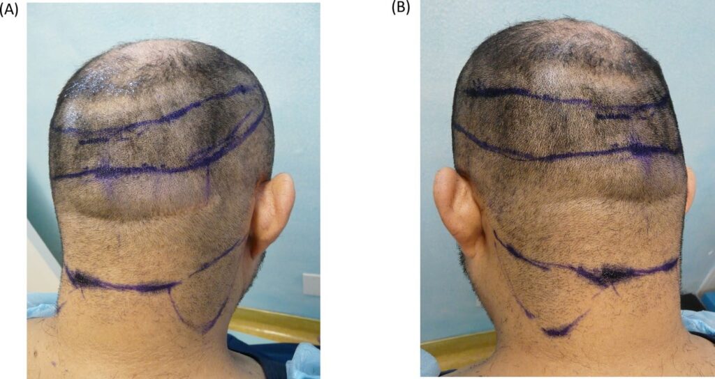 Rear and side views of clipped donor scalp, with blue markings and a sharp transition to thinner hair above the nape.