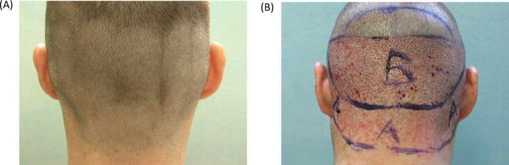Paired rear scalp views before and immediately after FUE, showing a gradual transition into the nape and marked extraction zones.