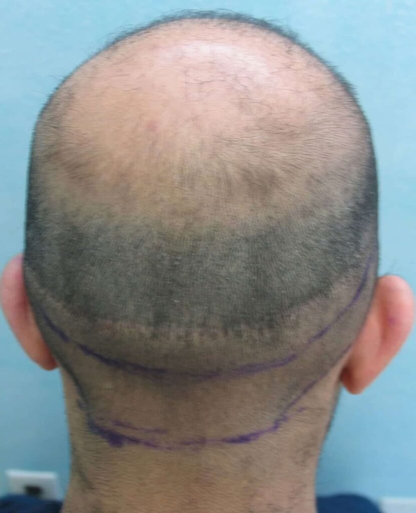 Rear view of clipped scalp showing a horizontal strip scar within a lower region of thinning hair.