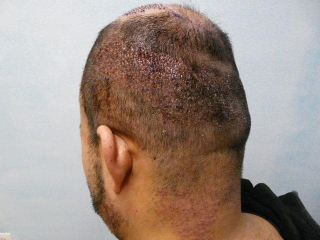 Side and rear scalp view after FUE, showing selected extraction sites on the upper scalp and upper neck.