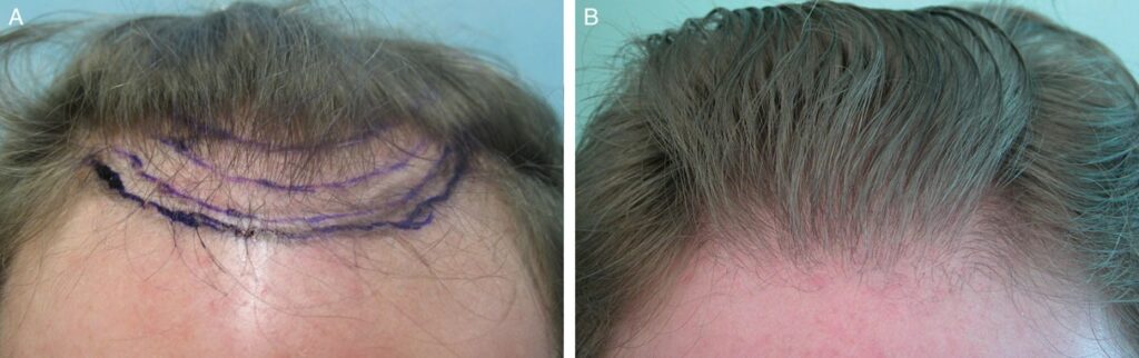 Before surgery and two years after hairline restoration using predominantly nape and periauricular grafts.