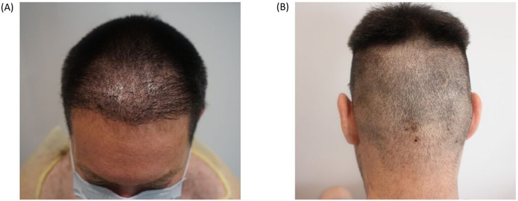 Frontal and rear scalp views fourteen years after FUE, with thinning behind the frontal hairline and hair over the nape.