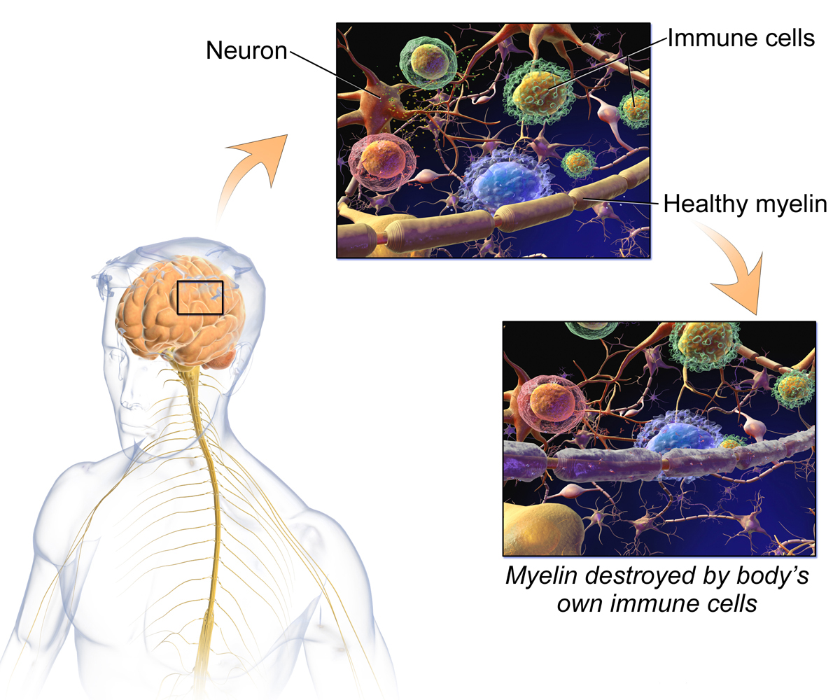 The Surprise Origin of Multiple Sclerosis in Europe » Explorersweb