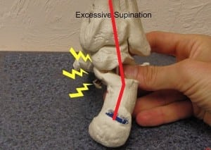 Achilles - Supination