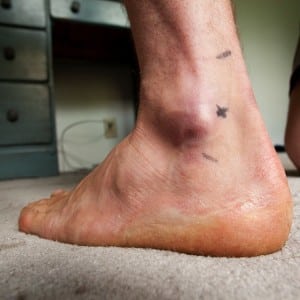 Joel Wolpert - ankle