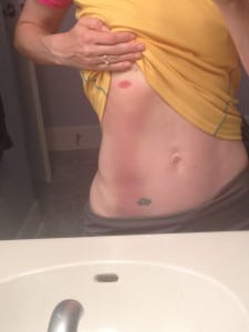 Pam Smith - 2013 Western States 100 - pack bruising