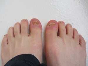 Pam Smith - three weeks post-toenail surgery