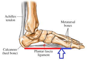 Fascial loading with a forefoot (walk or run) strike. Note the long distance of the red lever with a forefoot strike, in relation to the heel bone, where the facia inserts – and the typical location of the strain. (Picture courtesy of WebMd.com, amended by Joe Uhan)