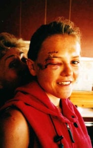 Jo Meek - after bike crash