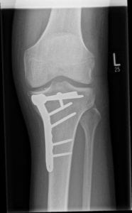 Morgan Williams 3 - knee xray