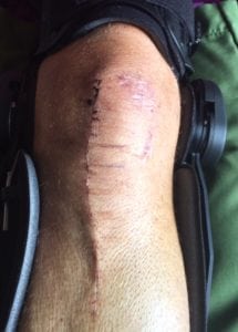 Morgan Williams 1 - knee scar