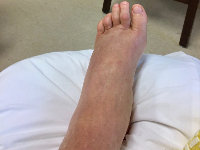 Trail First Aid Snakebites in North America iRunFar