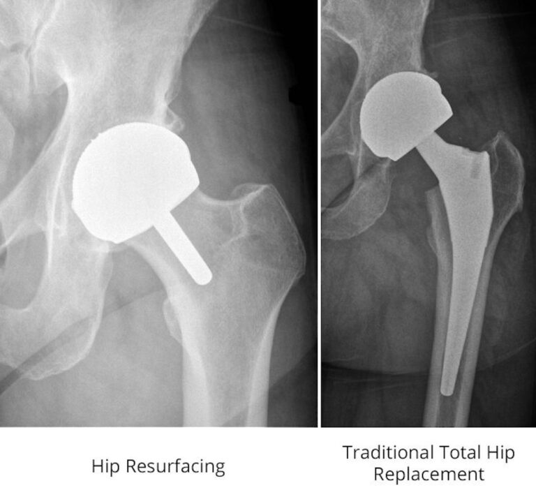 Hip Resurfacing vs Replacement