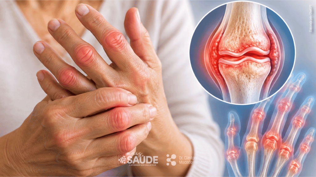 Mais-saude-Site-Thumbs-Artrite-reumatoide
