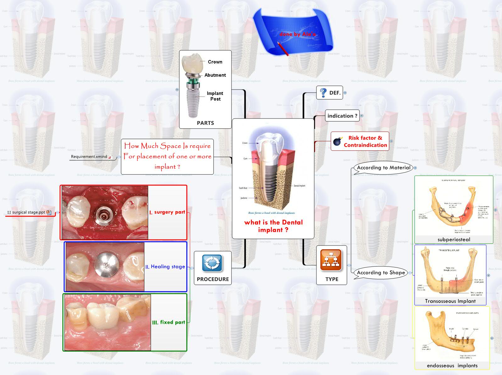 what is the Dental implant ? Ala'a Otaibi Xmind